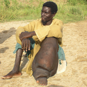 A man is sitting on the sandy ground, with his knees up. One of his legs and feet is very large and swollen through disease.